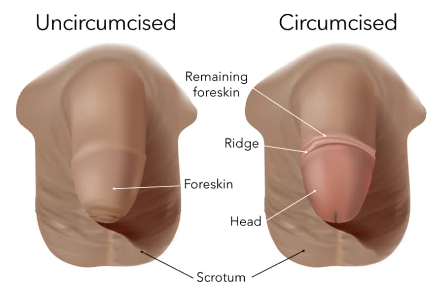 Phimosis, Circumcision