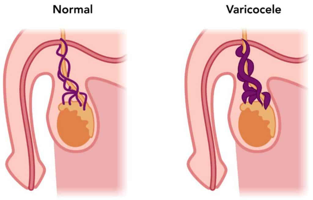 Male infertility