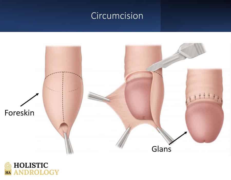 Phimosis Symptoms: Circumcision Specialists in NYC - Adult