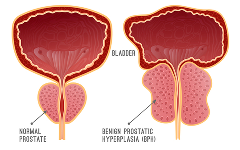 Does an Enlarged Prostate Affect a Man Sexually? 